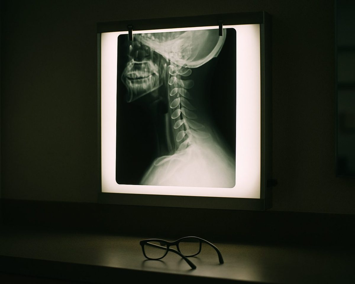 A cervical spine x-ray clipped to a glowing wall lightbox in a dim office, reading glasses on the counter below